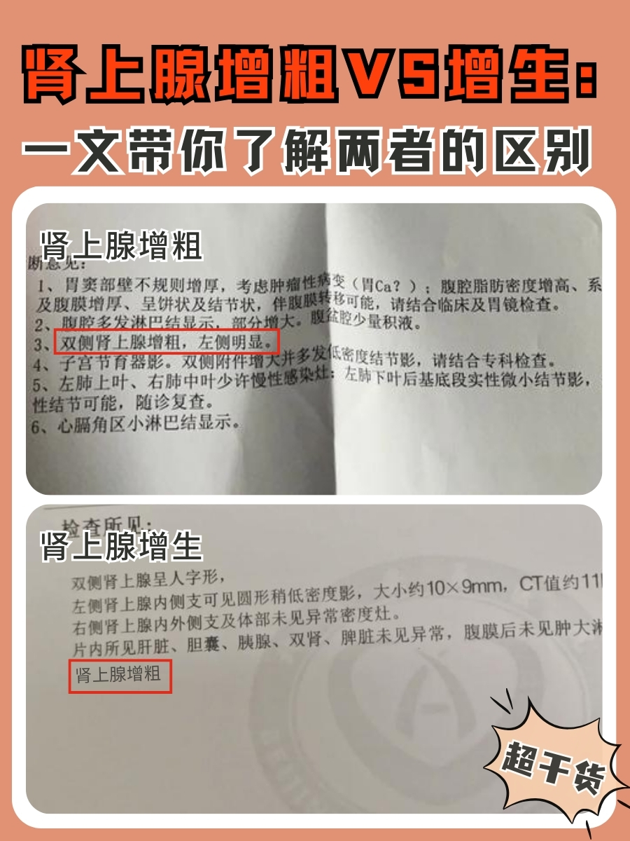 肾上腺增粗VS增生:一文带你了解两者的区别