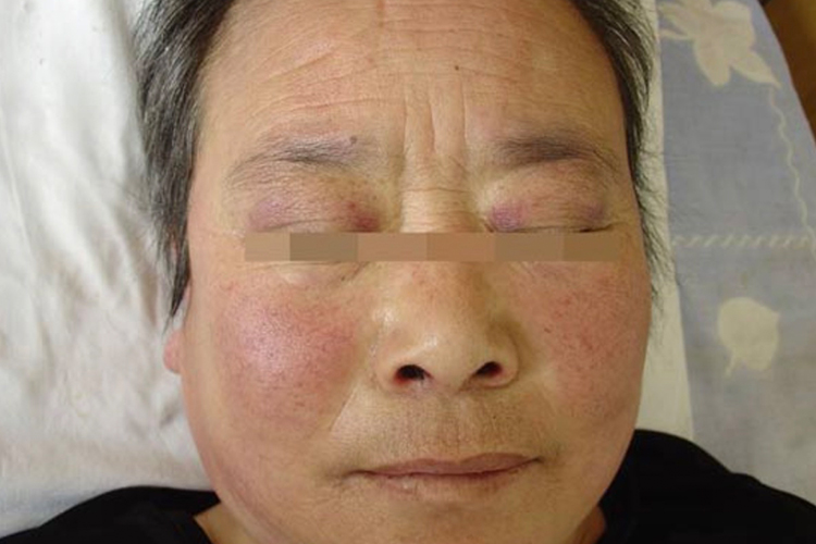 皮肌炎眼睑紫红色斑图