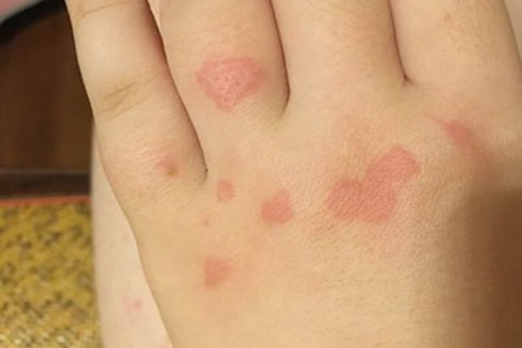 月经疹手背长扁平红斑图