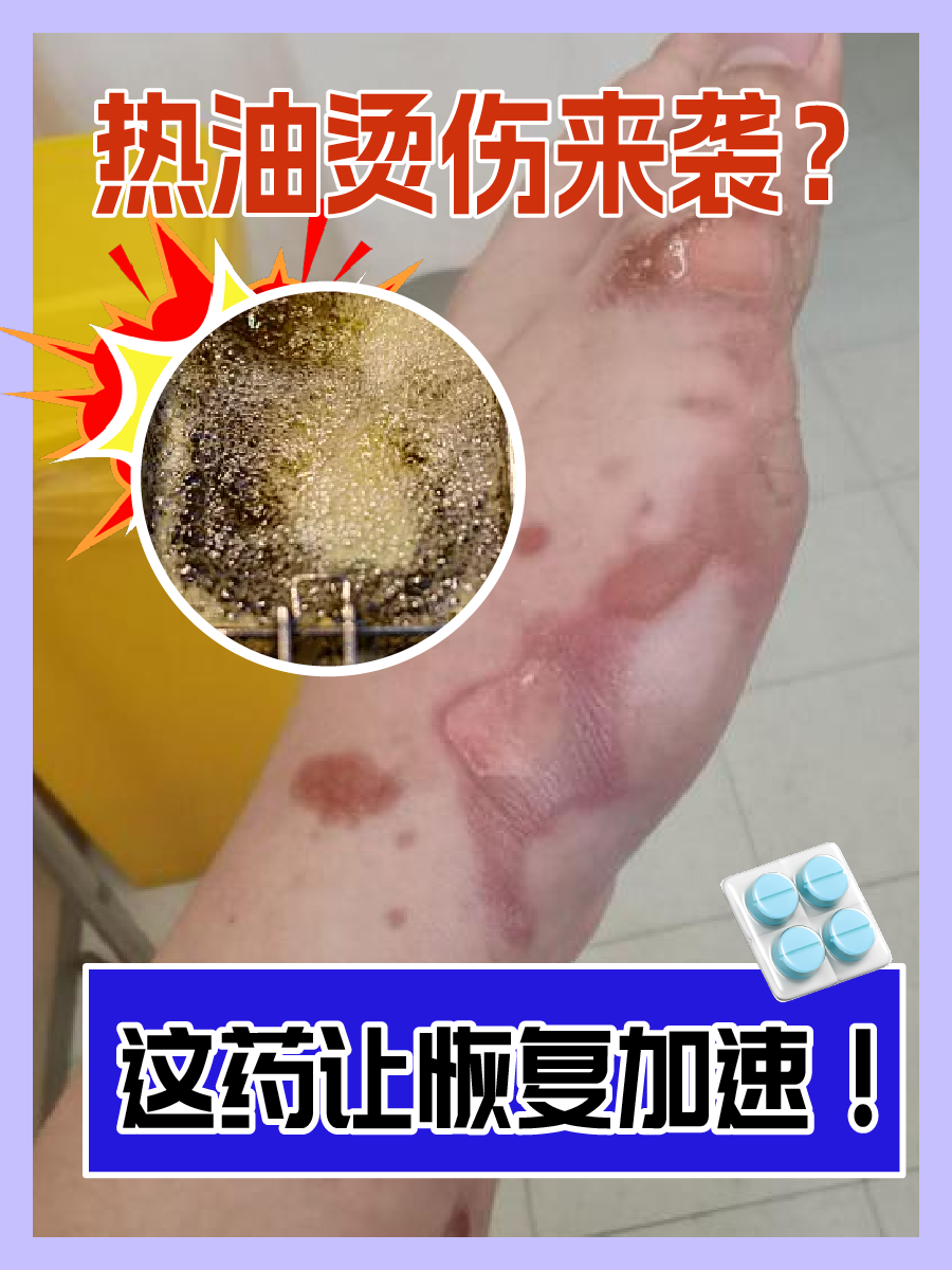 热油烫伤来袭?这药让恢复加速!