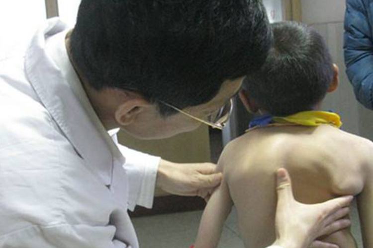 佝偻病脊柱侧弯图