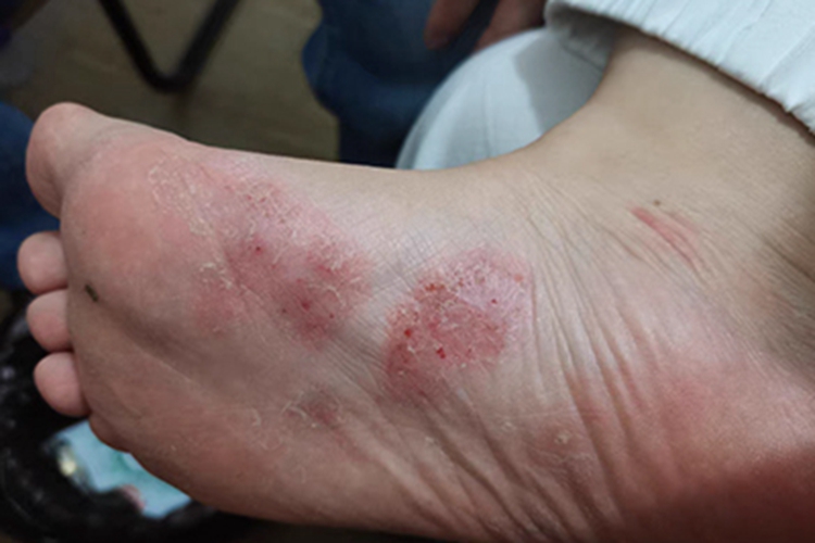 湿疹脚底红斑图片