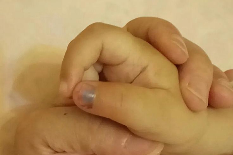 手指夹伤瘀血图 手指夹伤瘀血图