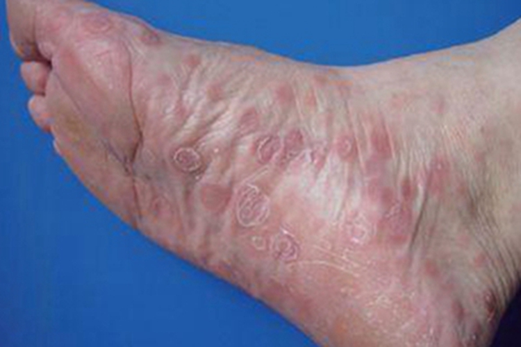 女性二期梅毒脚部脱皮图