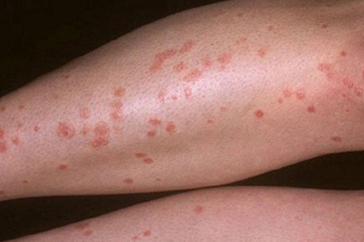 艾滋病期小腿症状图 艾滋病期小腿症状图