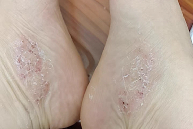 鳞屑角化型足癣脚部症状图 鳞屑角化型足癣脚部症状图