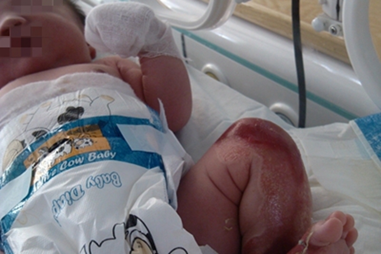 单纯型大疱性表皮松解症腿糜烂图 单纯型大疱性表皮松解症腿糜烂图