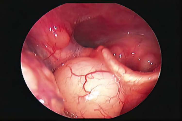 黄蚂蚁咬人喉头水肿图 黄蚂蚁咬人喉头水肿图