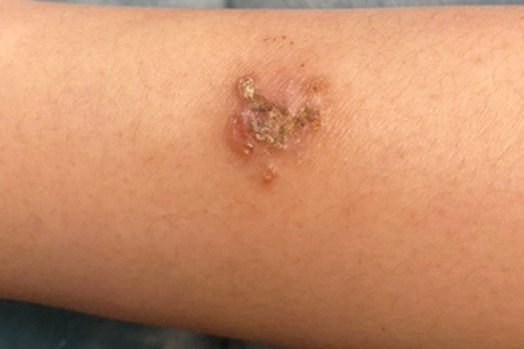 钱币状湿疹腿结痂图 钱币状湿疹腿结痂图