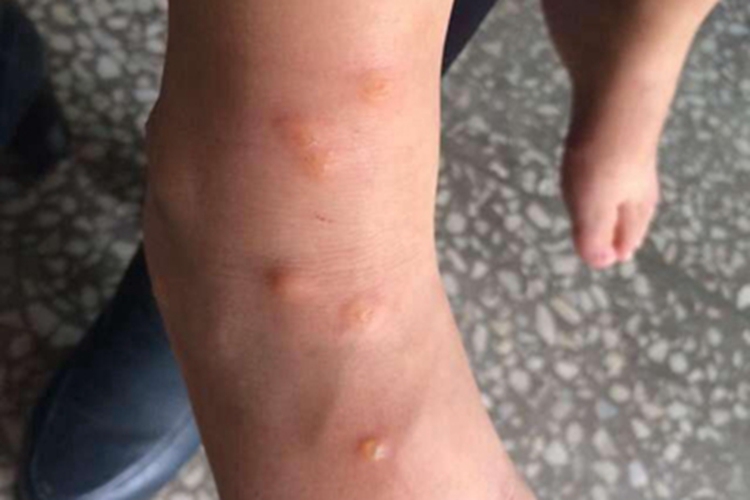 蠓虫叮咬引起的皮肤反应水疱图