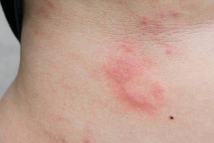 感染性荨麻疹腹部症状图