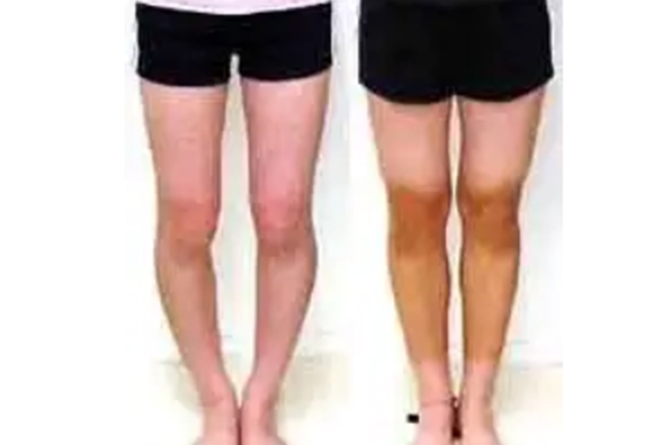 罗圈腿双膝无法并拢图和正常腿图 罗圈腿双膝无法并拢图和正常腿图