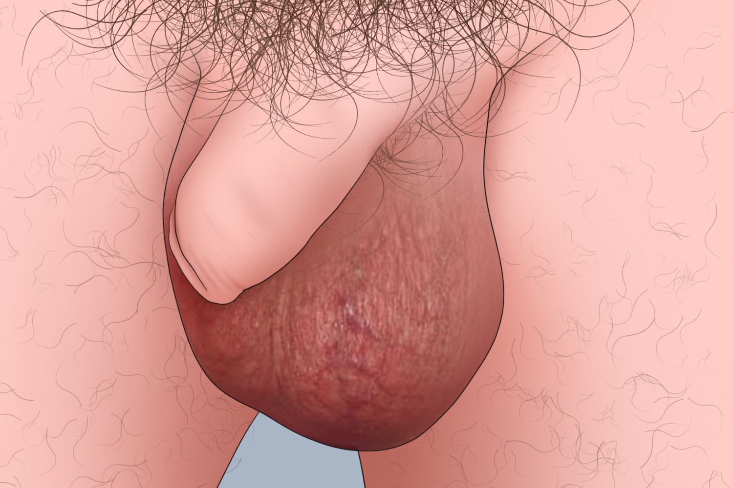 男性附睾囊肿图 男性附睾囊肿图