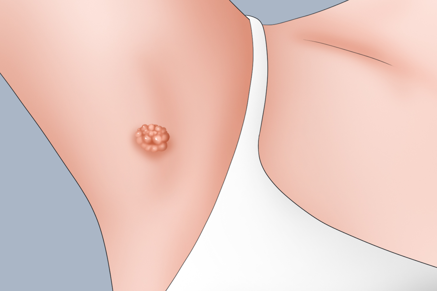 腋窝尖锐湿疣图 腋窝尖锐湿疣图