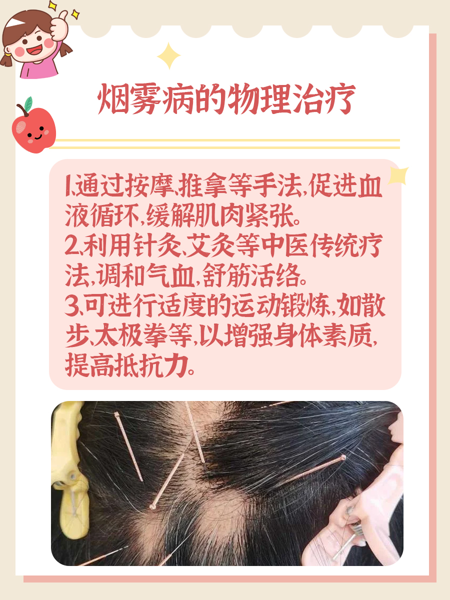 烟雾病1至6期怎么分？快来对照看看！