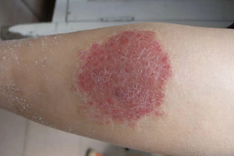 钱币状湿疹胳膊皮肤长斑图