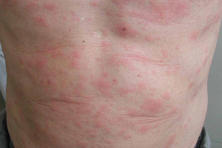 过敏红斑图 过敏红斑图