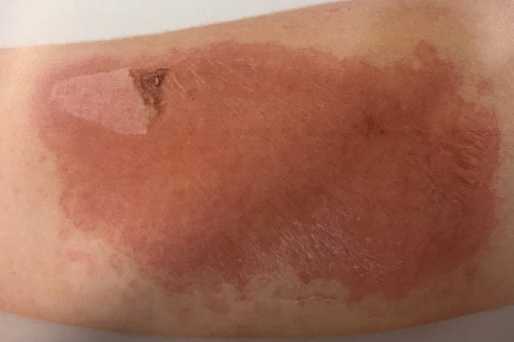 轻度火疮局部红斑图 轻度火疮局部红斑图