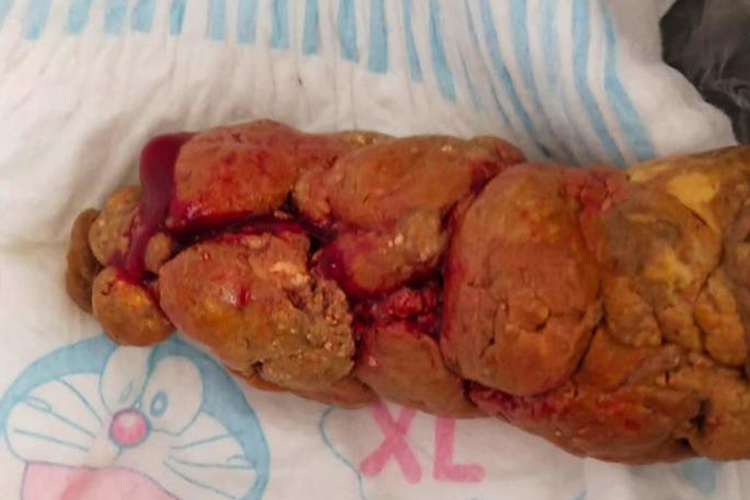 肠道出血大便图