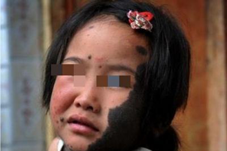 兽皮痣面部发黑图