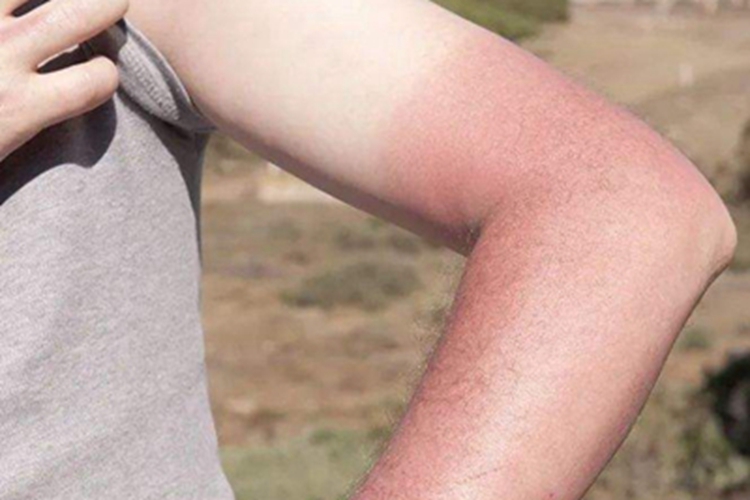 光毒性接触性皮炎胳膊红斑图