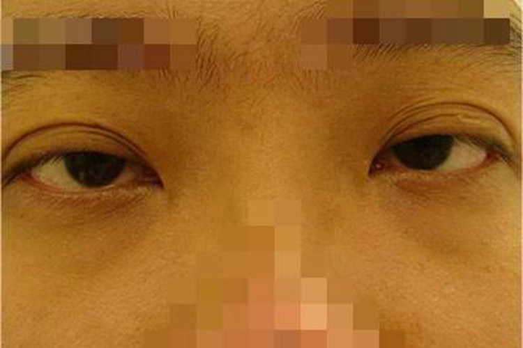 海蛇咬伤上睑下垂图 海蛇咬伤上睑下垂图