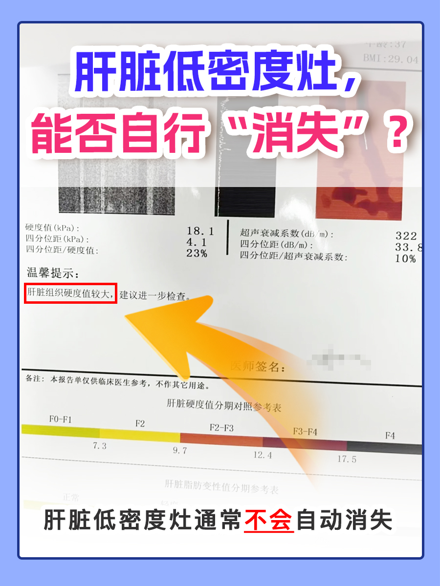肝脏低密度灶，能否自行“消失”？