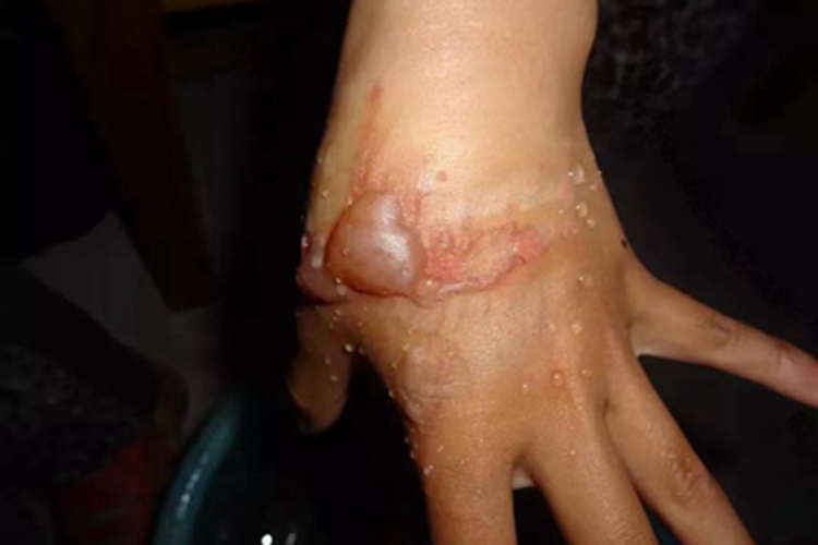 二度烫伤手背大水疱图