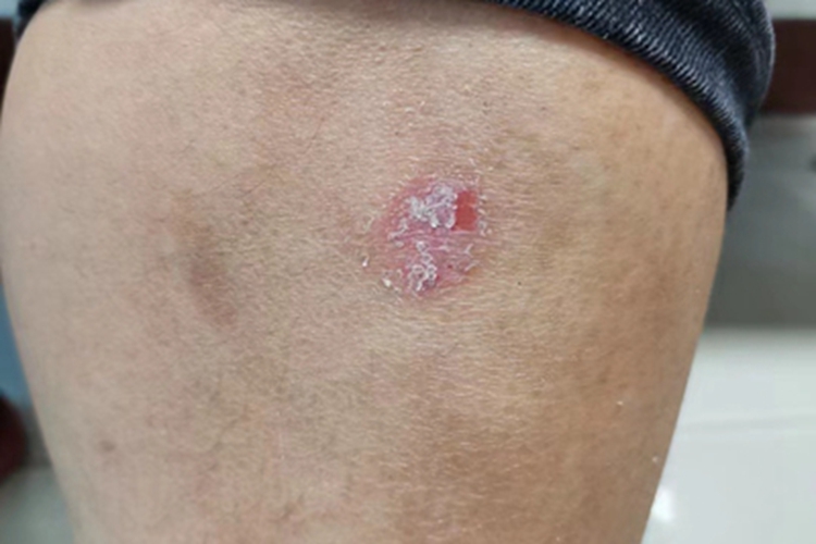 寻常型银屑病小腿斑图 寻常型银屑病小腿斑图