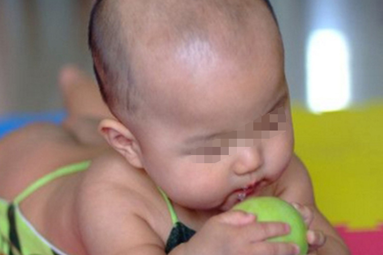 佝偻病宝宝方颅图