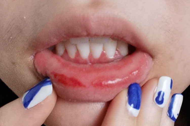 过敏性接触性口炎红斑图