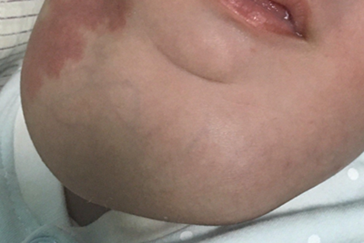 囊状淋巴管瘤颈部包块图 囊状淋巴管瘤颈部包块图