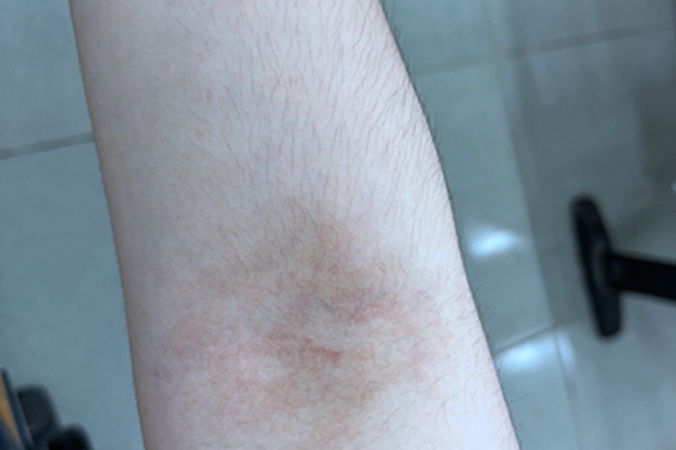 慢性湿疹胳膊皮肤颜色加深图 慢性湿疹胳膊皮肤颜色加深图