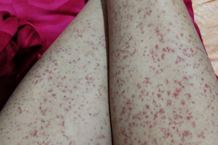 过敏性紫癜小腿有红点图