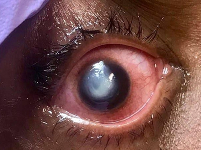 匐行性角膜溃疡黑眼球上有白色斑图.jpg