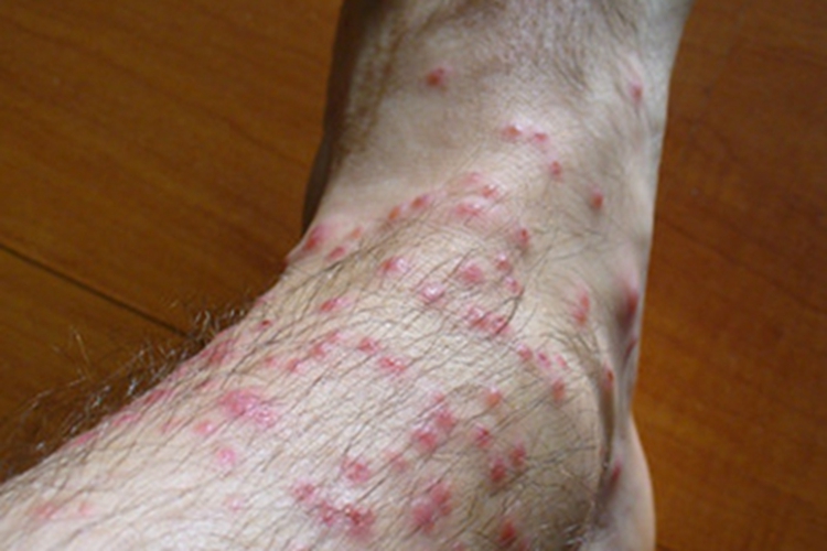恙螨皮炎脚踝小红疙瘩图