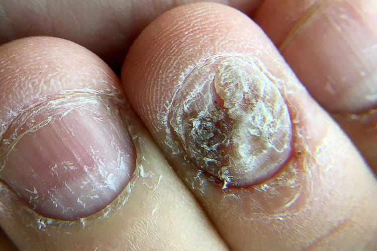 真菌感染指甲早期图片图片