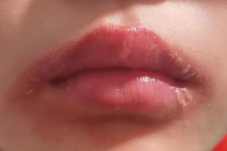 口周急性湿疹口周红斑图