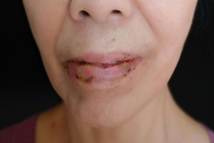 寻常型天疱疮嘴唇血痂图 寻常型天疱疮嘴唇血痂图