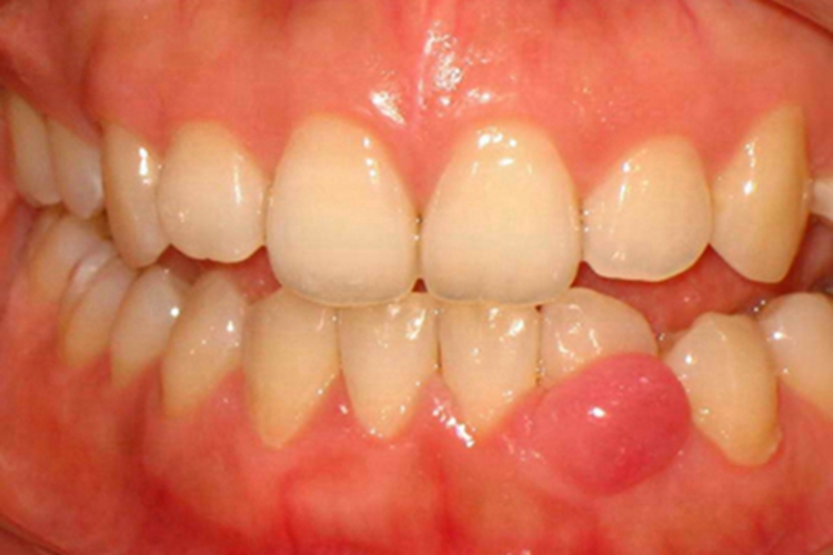 牙龈炎下牙龈一处红肿图 牙龈炎下牙龈一处红肿图