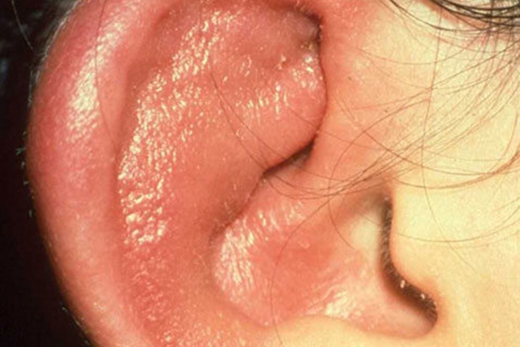 青少年春季疹耳廓症状图片