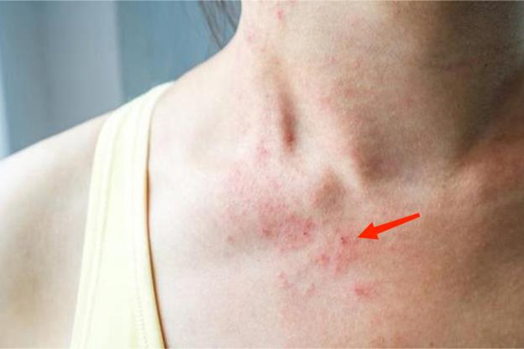 镍皮炎胸部结痂图