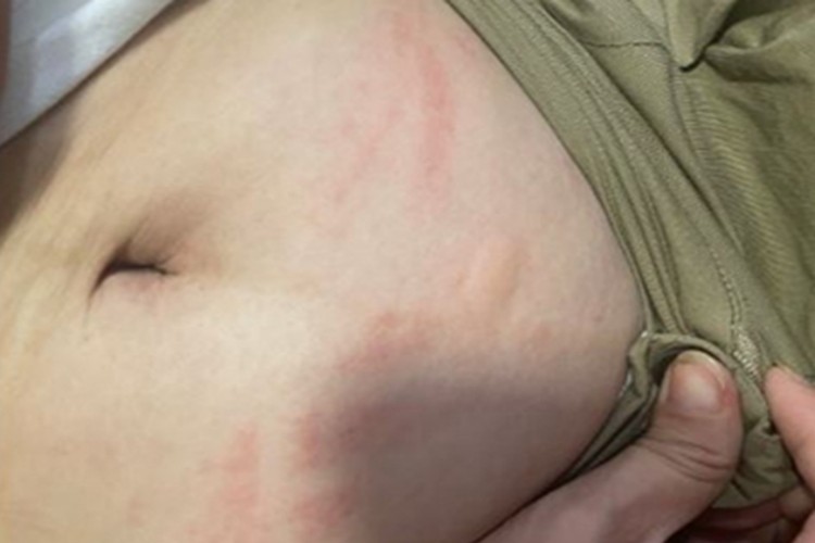 急性自发性荨麻疹腹部红斑图