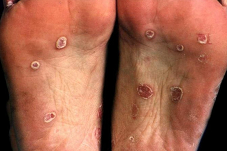 三期梅毒脚底症状图 三期梅毒脚底症状图