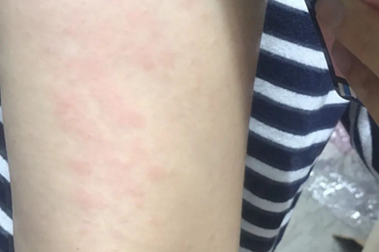 成人Still病胳膊症状图 成人Still病胳膊症状图