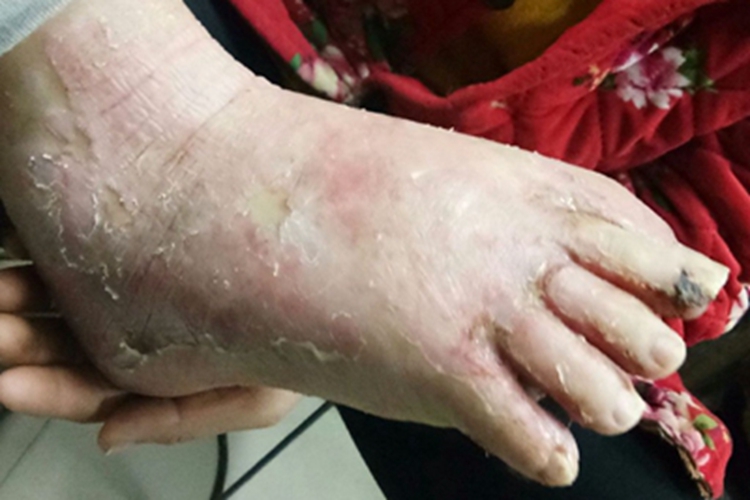 肠病性肢端皮炎脚背脱皮图