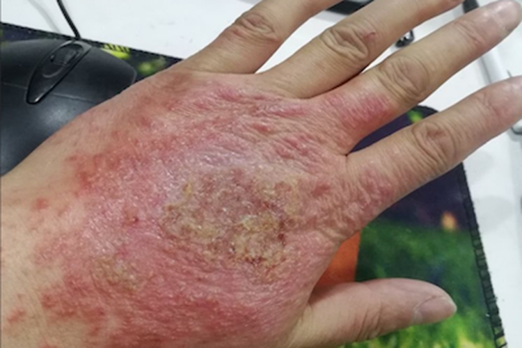 亚急性湿疹手部斑图 亚急性湿疹手部斑图