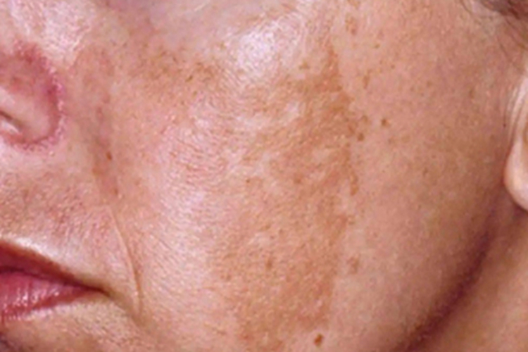 黧黑斑脸颊上有褐色斑图