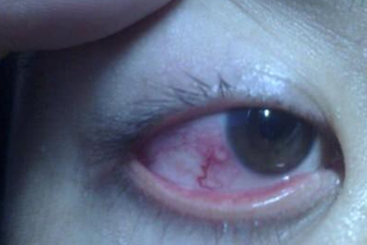 泡性结膜炎白色结节图 泡性结膜炎白色结节图