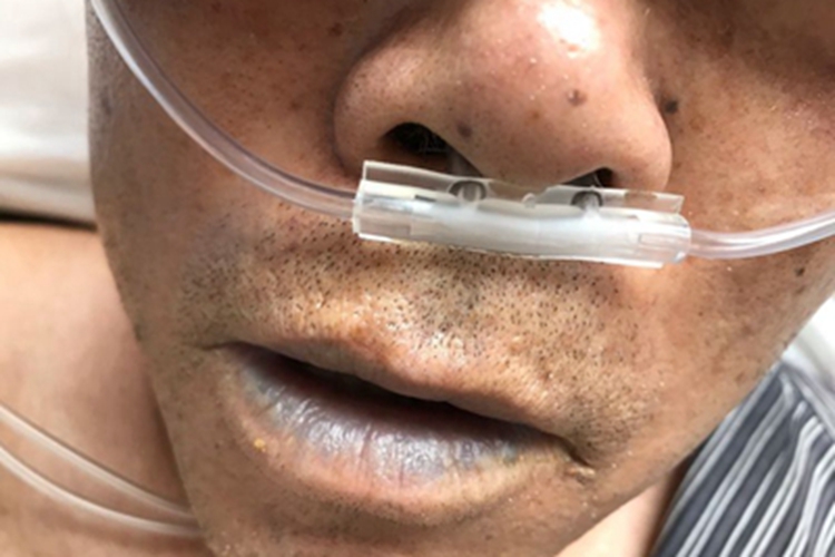 炭疽病嘴唇发紫图 炭疽病嘴唇发紫图